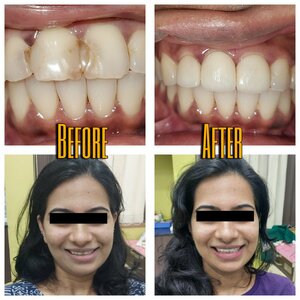 Long-Lasting Smile Makeover with Ceramic Veneers in Karvenagar